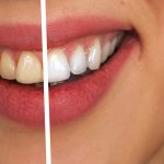 A Comprehensive Guide to Dental Bonding – Process, Costs, and Benefits